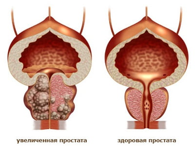 Норма размеров предстательной железы при УЗИ