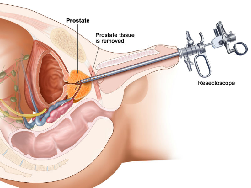 Трансуретральная резекция предстательной железы