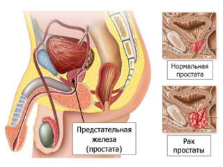 Как выглядит рак предстательной железы