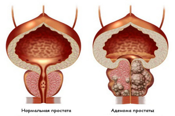 Увеличенная простата: аденома