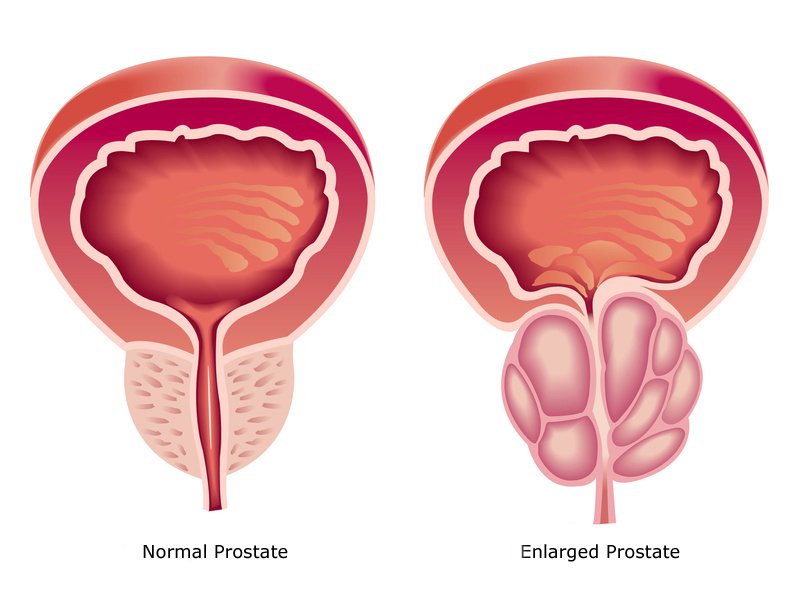 Здоровая простата и зараженная бактериальным простатитом